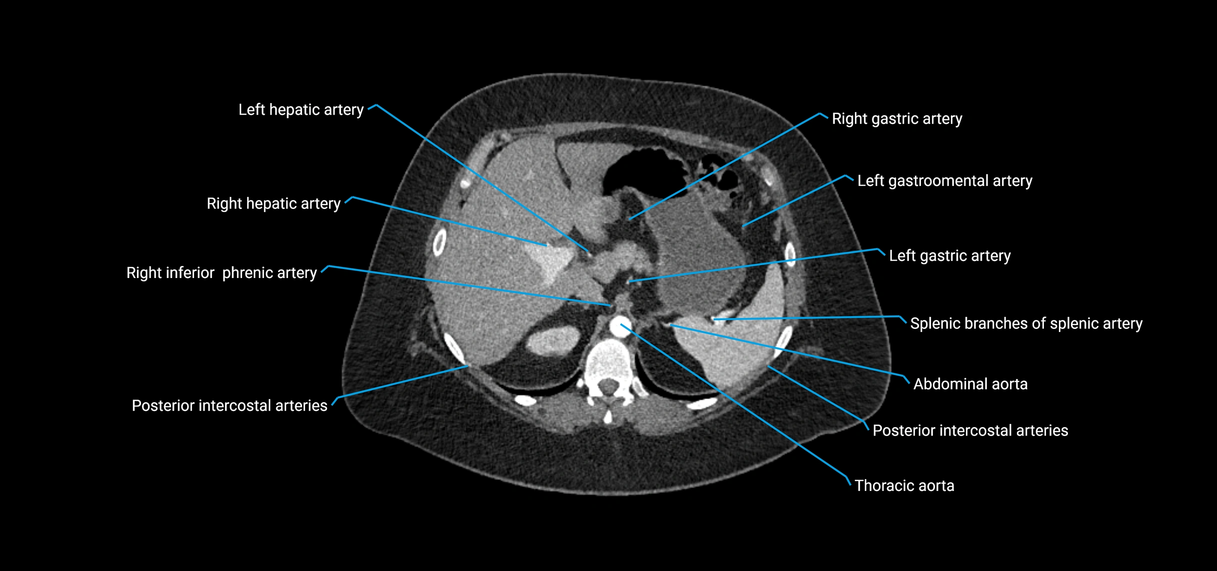 CTA abdomen axial cross sectional anatomy labelled image_43 (2).webp